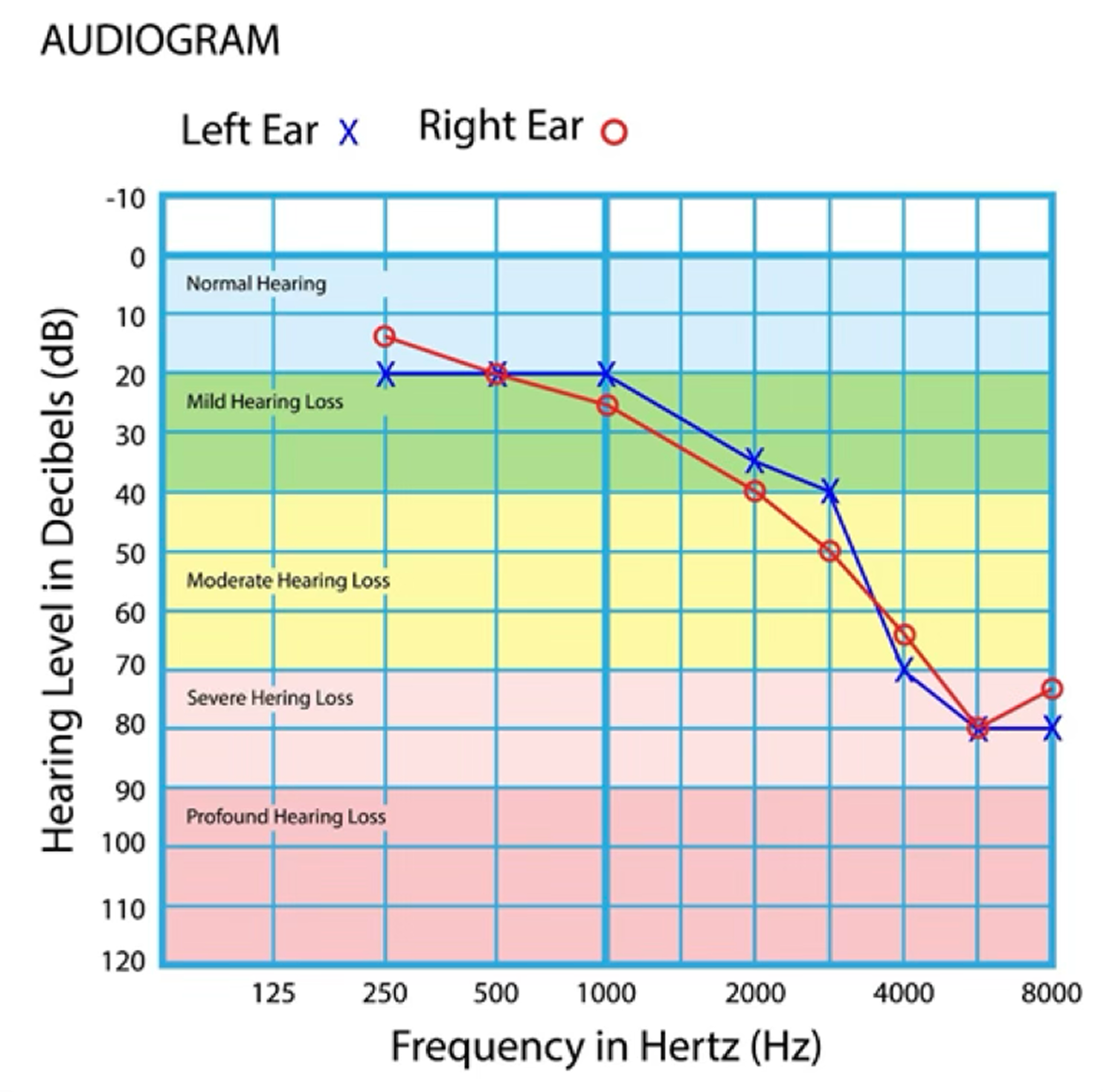 Audiogram by MDHearing showing sensorineural hearing loss